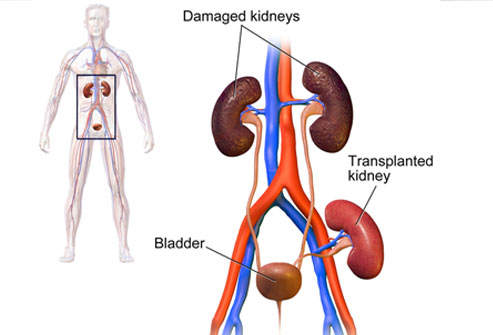 Kidney Transplant Second Opinion 1