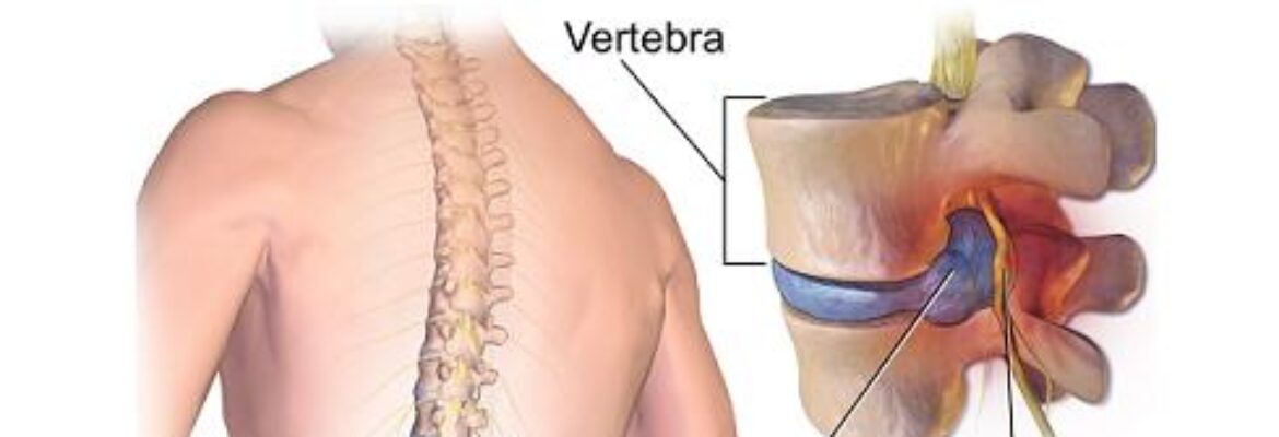 Lumbar Disc Replacement Surgery Hospitals in Lagos – Find Reviews and Cost Estimate