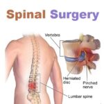 Spine Surgery in Lagos