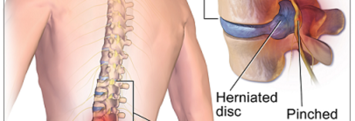 Discectomy Surgery Hospitals in Nairobi – Find Cost Estimate, Reviews and Book Appointment