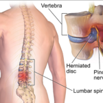 Spinal Surgery in Nairobi