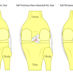 ACL Reconstruction cost in Lagos
