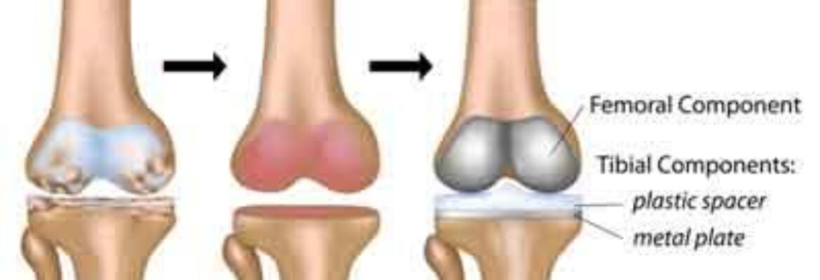 Knee Replacement Cost in Lagos – Find Best Knee Replacement Surgeons, Reviews, Success Rate