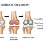 Knee Replacement in Lagos