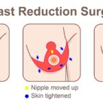 Breast Reduction Surgery Cost in Nairobi