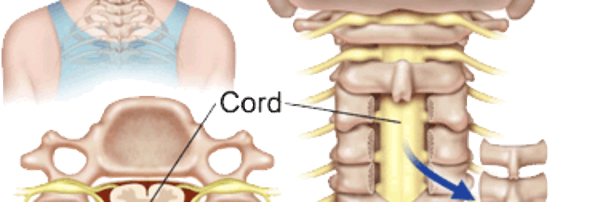 Cervical Laminectomy Surgery Cost in Lagos- Find the Best Surgeons, Reviews and  Book Appointment