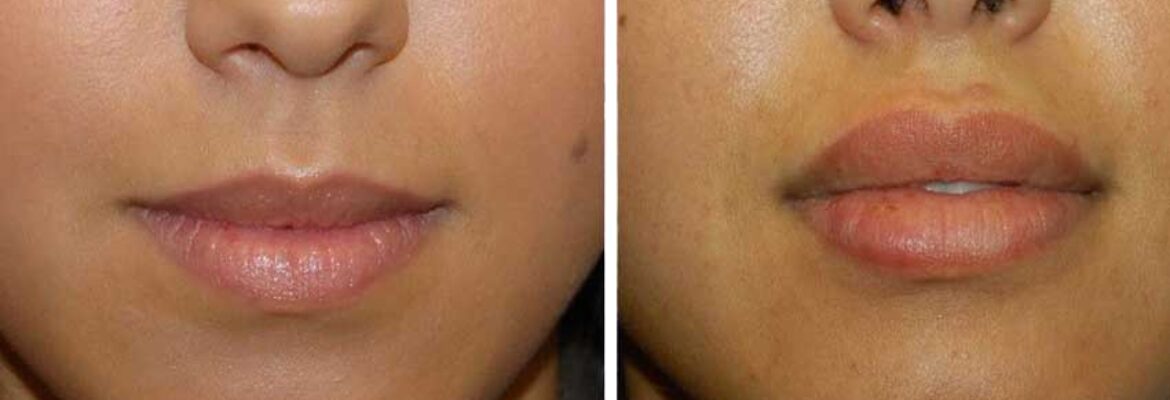 Lip Reduction Surgery Cost in Nairobi- Find the Best Surgeons, Reviews and  Book Appointment