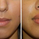 Lip Reduction Surgery Cost in Nairobi