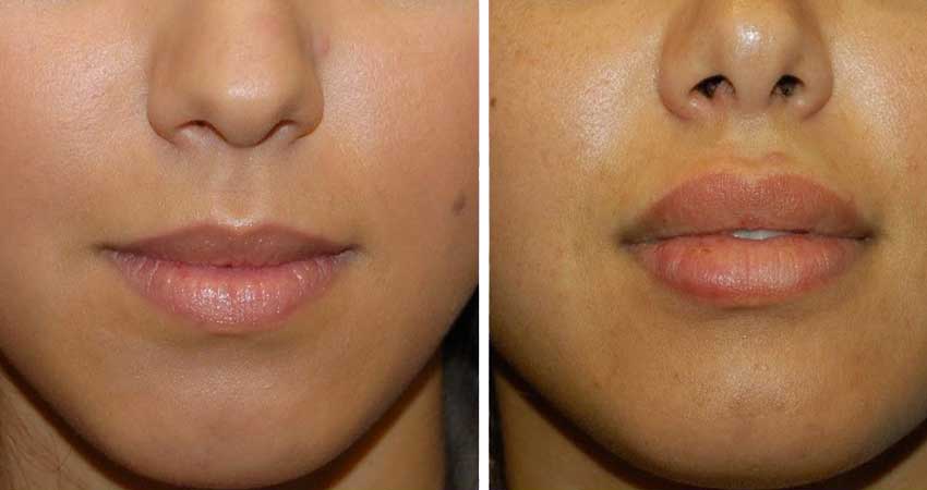 Lip Reduction Surgery Cost In Nairobi Find The Best Surgeons Reviews 