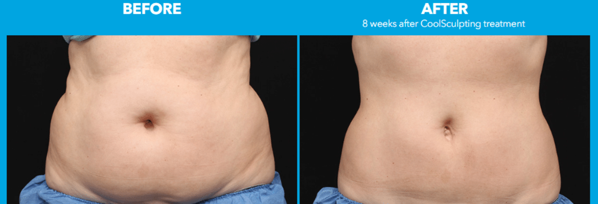 Coolsculpting Surgery Cost in Lagos- Find the Best Surgeons, Reviews and  Book Appointment