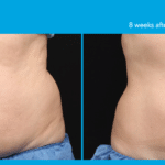 CoolSculpting cost in Lagos