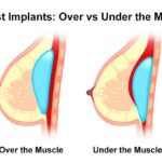 Breast Implants Surgery Cost in Nairobi