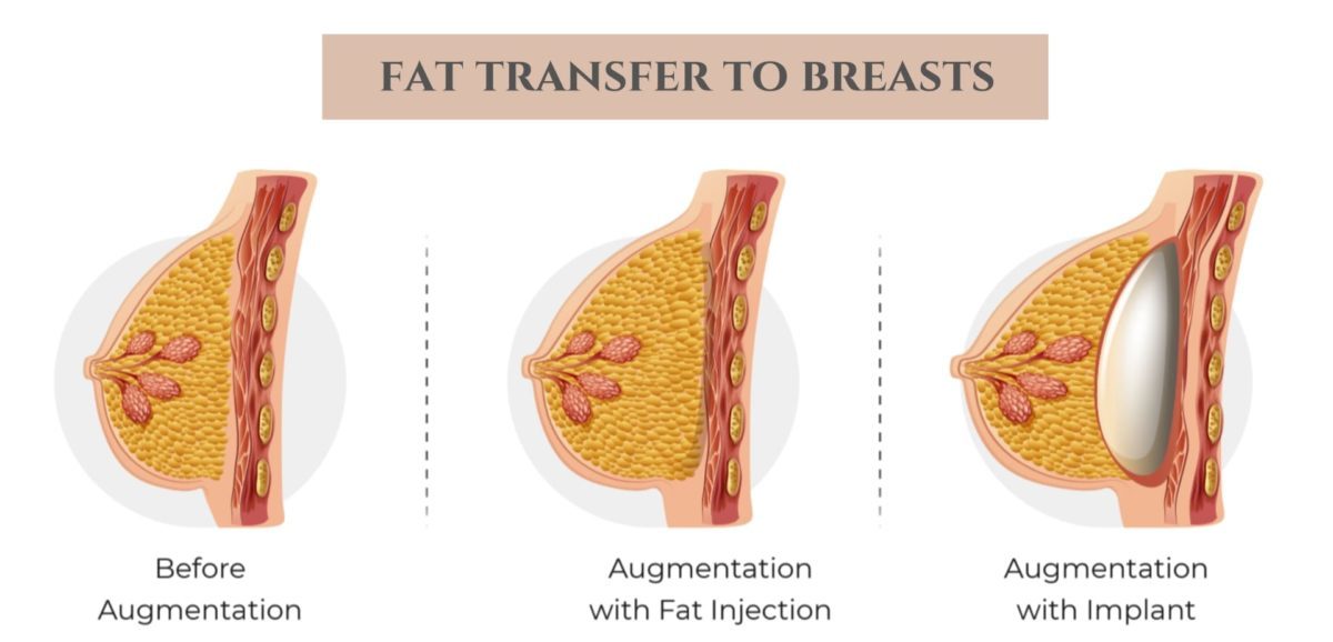 Breast Fat Transfer Surgery Cost in Nairobi- Find the Best Surgeons,  Reviews and Book Appointment - Africa Infoline