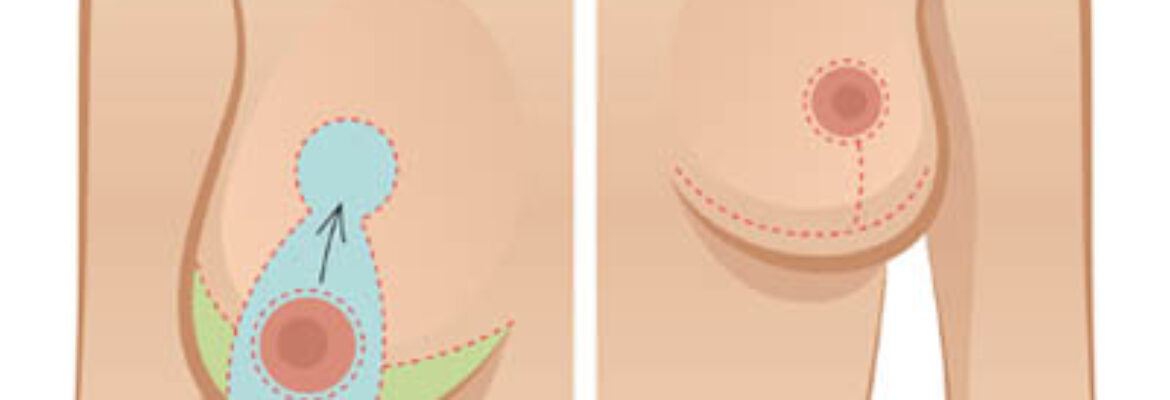 Breast Reduction Surgery Cost in Nairobi- Find the Best Surgeons, Reviews and  Book Appointment