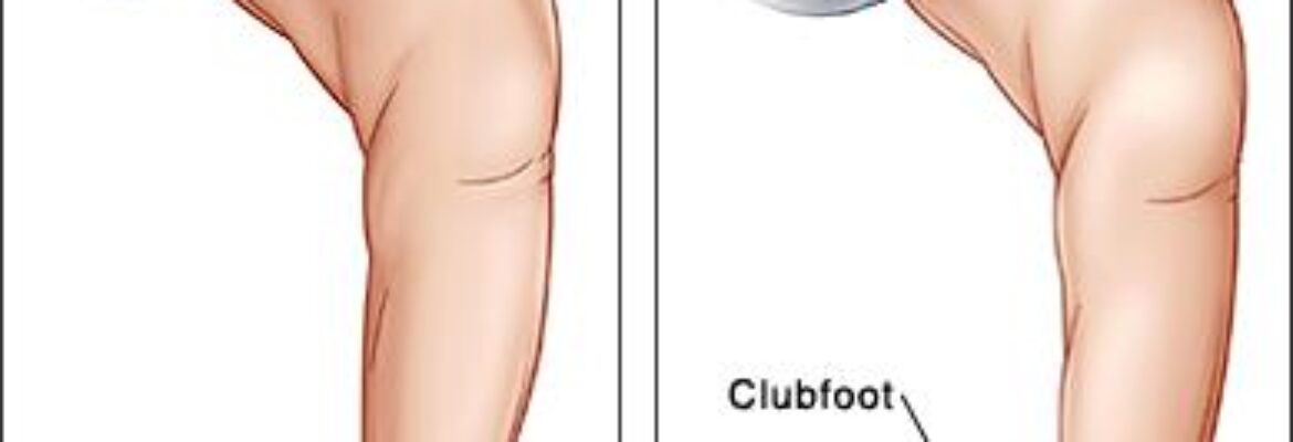 Club Foot Treatment Surgery Cost in Lagos – Find the Best Surgeons, Reviews and Book Appointment