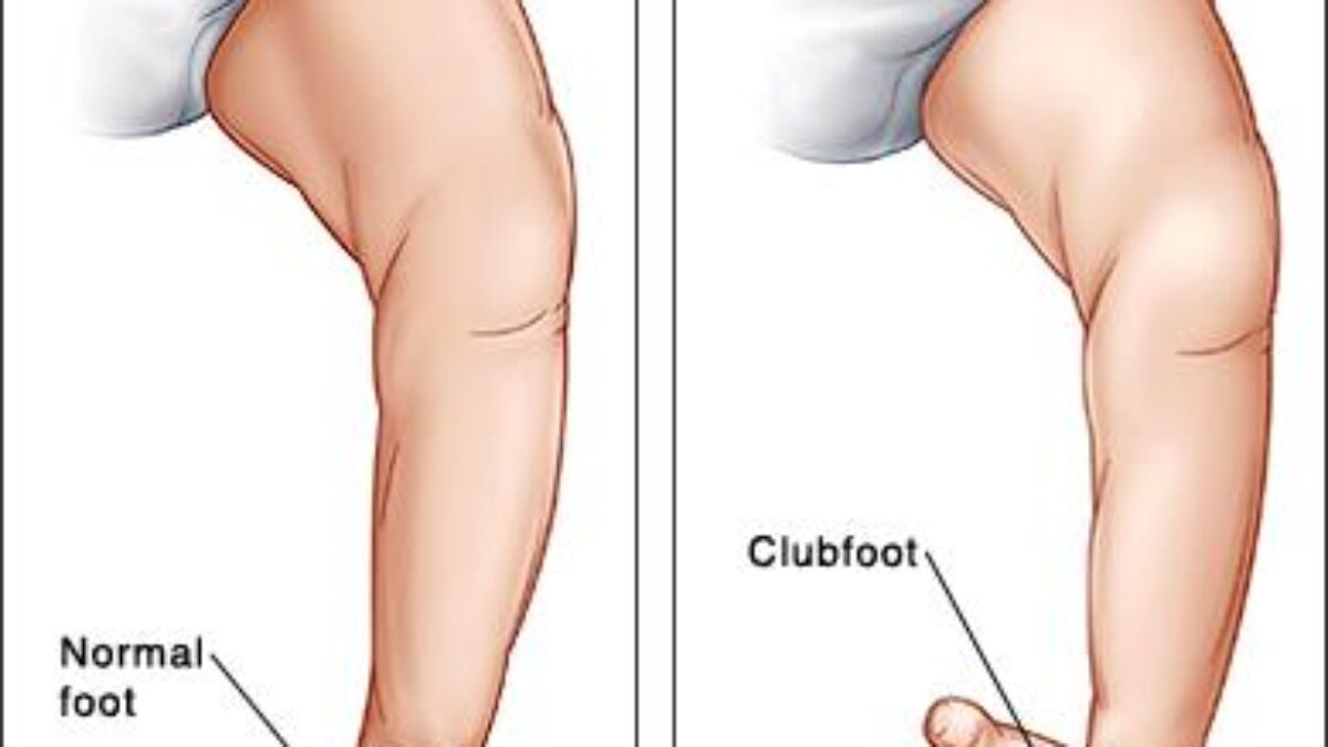 Club Foot Treatment Surgery Cost In Lagos Find The Best Surgeons Reviews And Book Appointment Africa Infoline