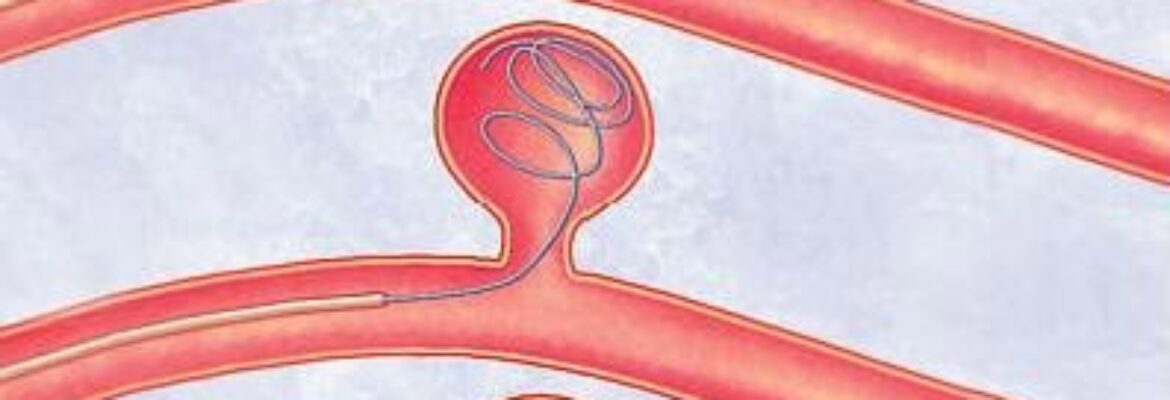 Aneurysm Coiling Surgery Cost in Lagos- Find the Best Surgeons, Reviews and  Book Appointment