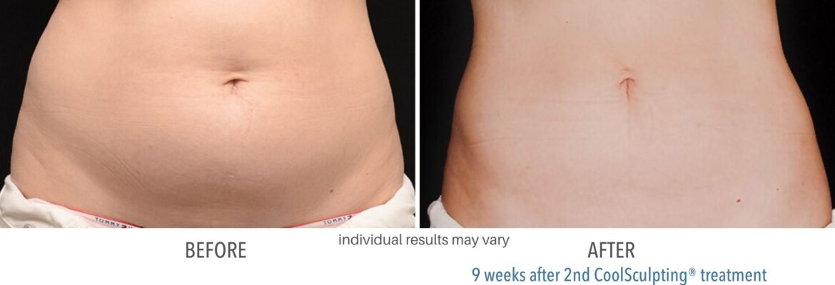 Coolsculpting Surgery Cost in Nairobi-Find the Best Surgeons, Reviews and  Book Appointment