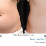 Coolsculpting surgery Cost in Nairobi