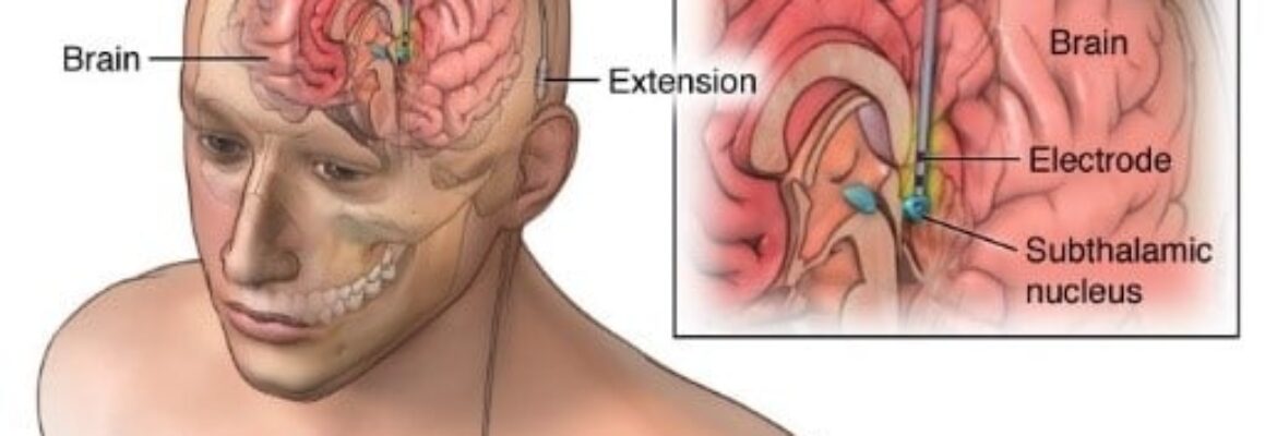 Deep Brain Stimulation Surgery Cost in Lagos- Find the Best Surgeons, Reviews and  Book Appointment