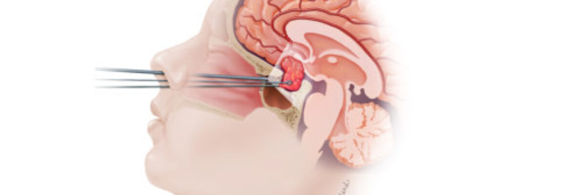 Endoscopic Pituitary Surgery Cost in Lagos- Find the Best Surgeons, Reviews and  Book Appointment