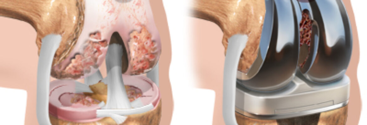 Knee Replacement  Surgery Cost in Lagos – Find the Best Surgeons, Reviews and Book Appointment