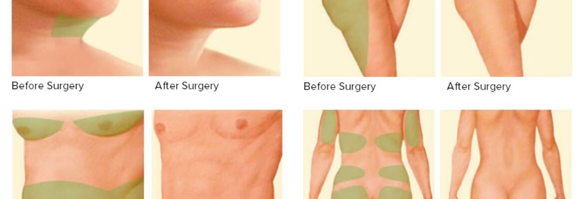 Liposuction Surgery Cost in Lagos- Find the Best Surgeons, Reviews and  Book Appointment