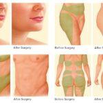 liposuction cost in Lagos