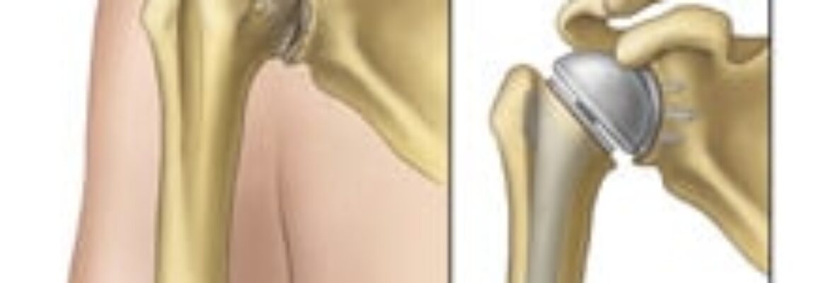 Shoulder Replacement Surgery Cost in Lagos- Find the Best Surgeons, Reviews and  Book Appointment