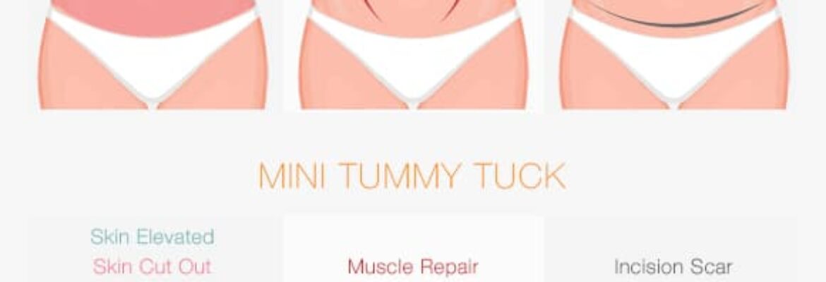 Tummy Tuck Surgery Cost in Nairobi- Find the Best Surgeons, Reviews and  Book Appointment