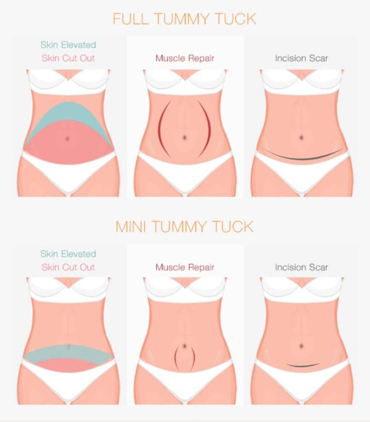 Tummy Tuck Surgery Cost In Nairobi Find The Best Surgeons Reviews And Book Appointment Africa Infoline