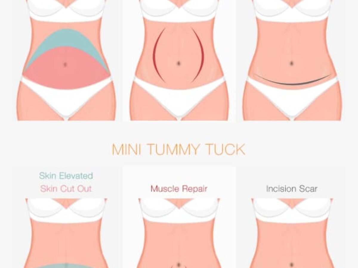 Tummy Tuck Surgery Cost In Nairobi Find The Best Surgeons Reviews And Book Appointment Africa Infoline