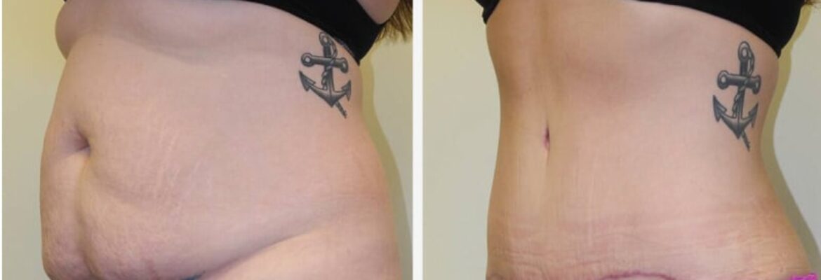 Tummy Tuck Surgery Cost in Lagos- Find the Best Surgeons, Reviews and  Book Appointment