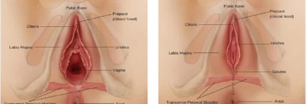 Vaginoplasty Surgery Cost in  Nairobi- Find the Best Surgeons, Reviews and  Book Appointment