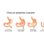 Bariatric Surgery in Lagos