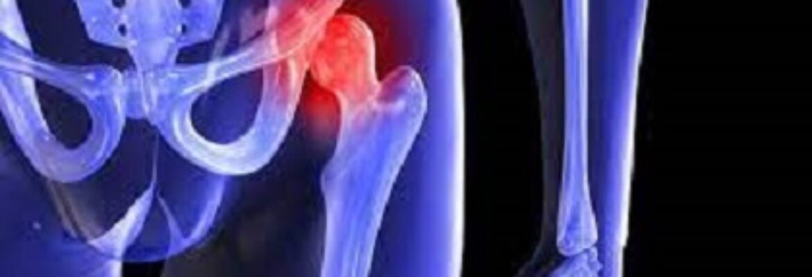 Hip Replacement Cost in Ikeja – Find Best Hospitals, Reviews and Book Appointment