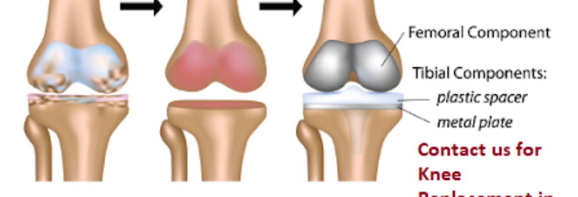 Knee Replacement Cost in Ojokoro – Find Best Hospitals, Reviews and Book Appointment