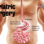 Bariatric Surgery Lagos