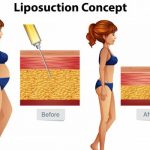 Liposuction cost in Kampala
