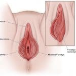 Vaginoplasty cost in Kampala