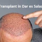 Hair Transplant in Dar es Salaam