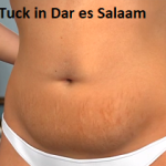 Tummy Tuck in Dar es Salaam