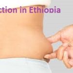 Liposuction in Ethiopia