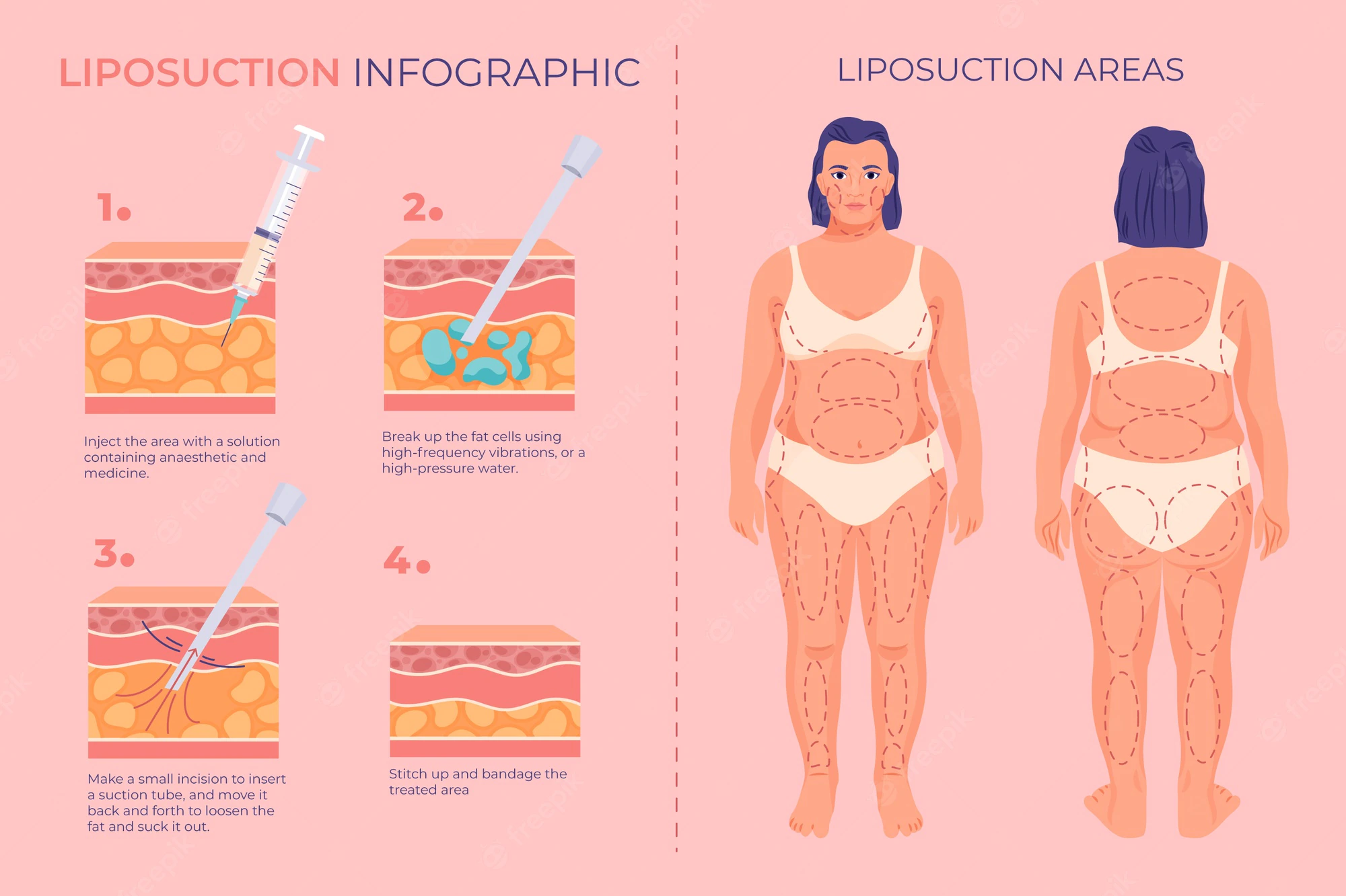 What is the cost of lipo injections in South Africa?