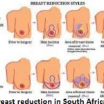 Breast Reduction in South Africa