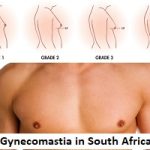 Gynecomastia in South Africa