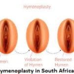 Hymenoplasty in South Africa