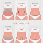 Tummy Tuck in South Africa