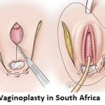 Vaginoplasty in South Africa