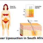 Vaser Liposuction in South Africa